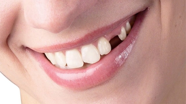 Ở một số nền văn hóa, mơ thấy rụng bốn chiếc răng được coi là một điềm xấu